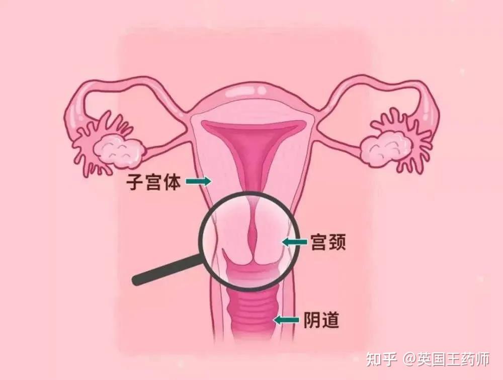 内生型宫颈癌图片图片