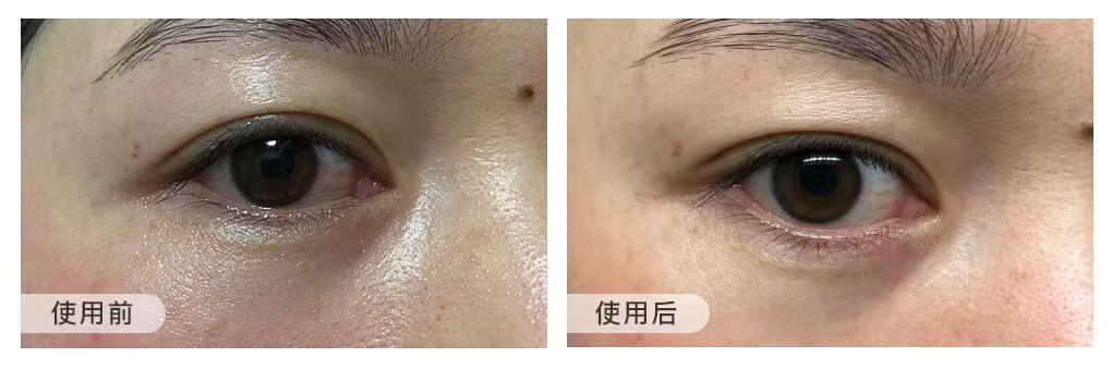 下眼睑皱纹很深怎么去除