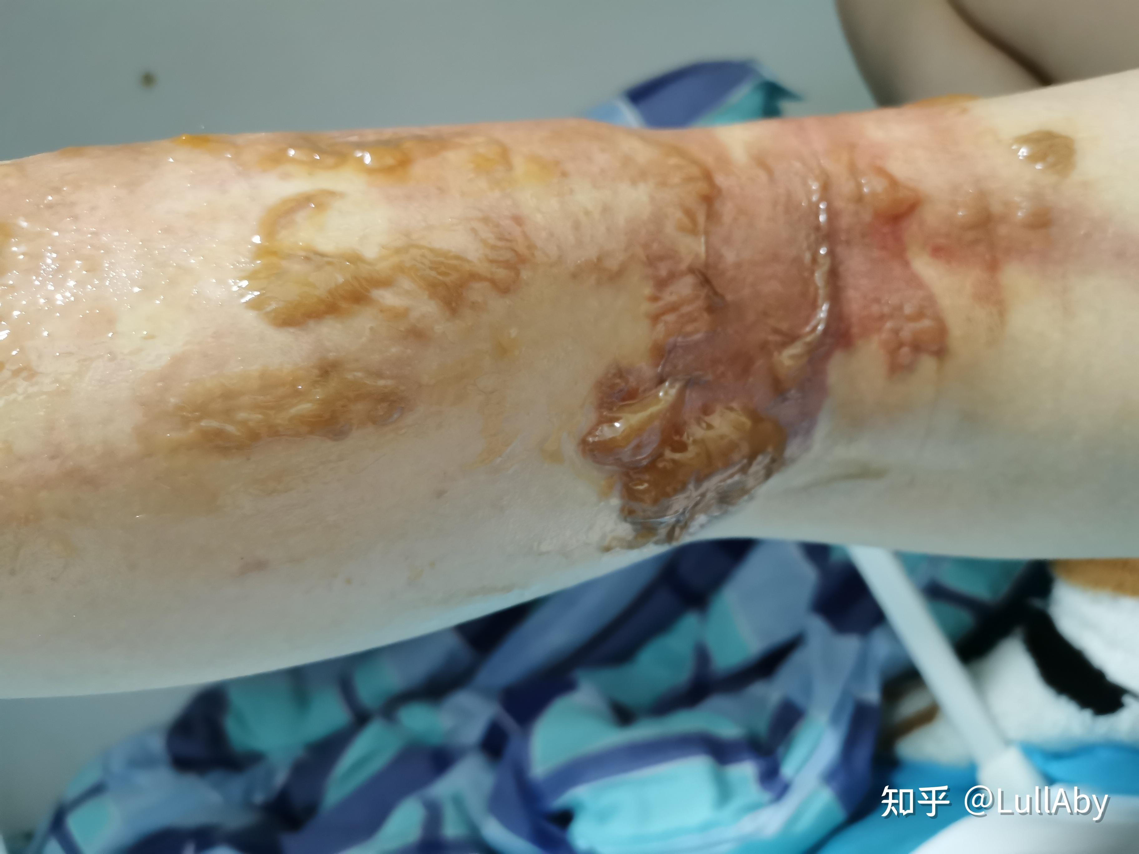 浅二度开水烫伤恢复过程