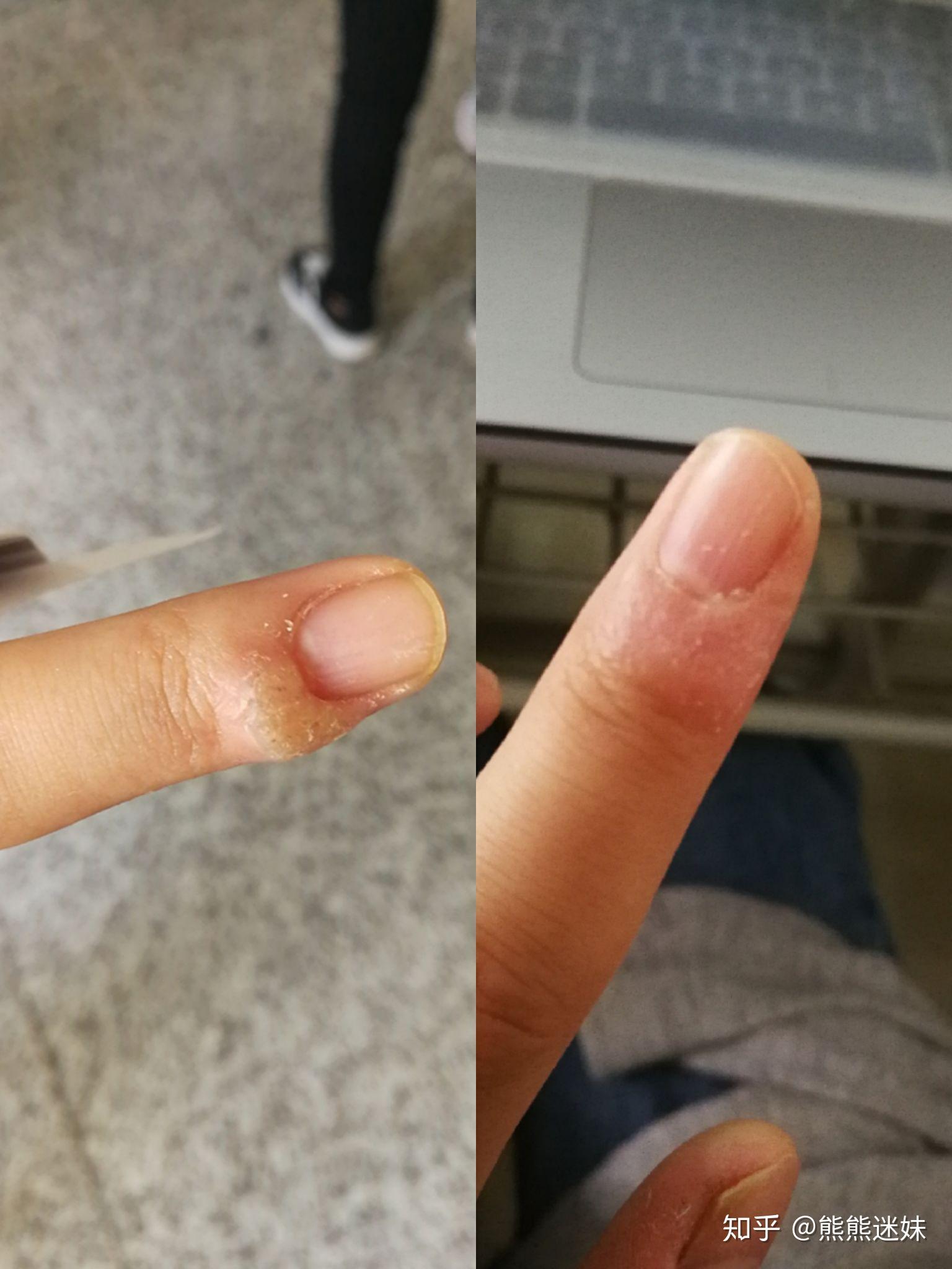 困扰了很多年的甲周疣在右手的中指上疣体已经占据了指甲的一半激光