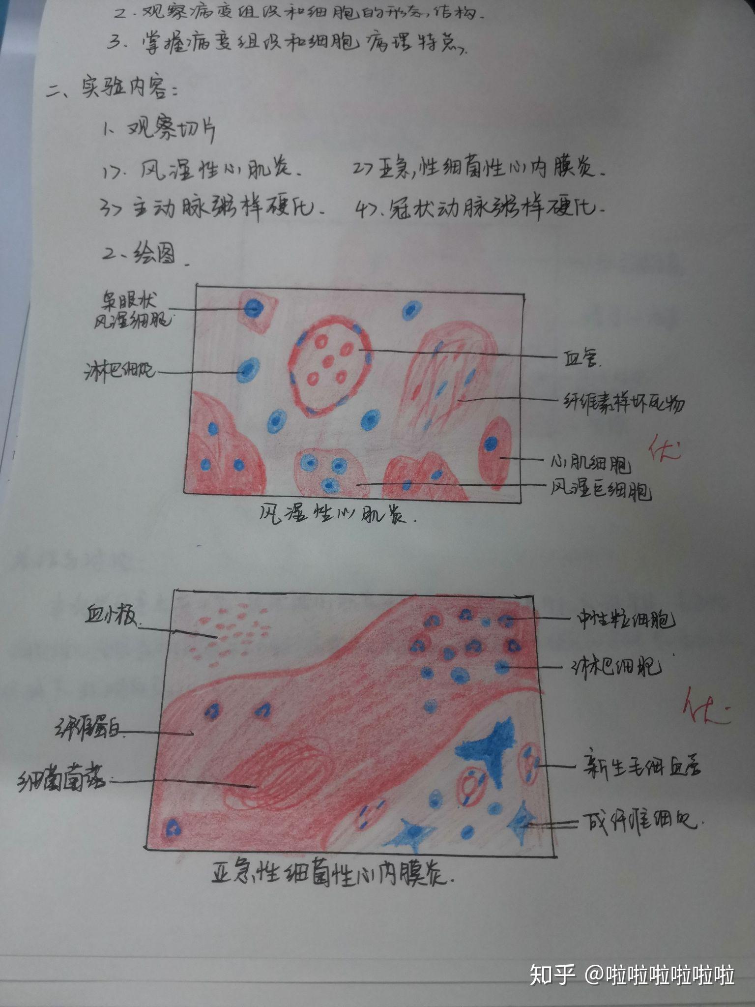 病理红蓝绘图鼻息肉图片
