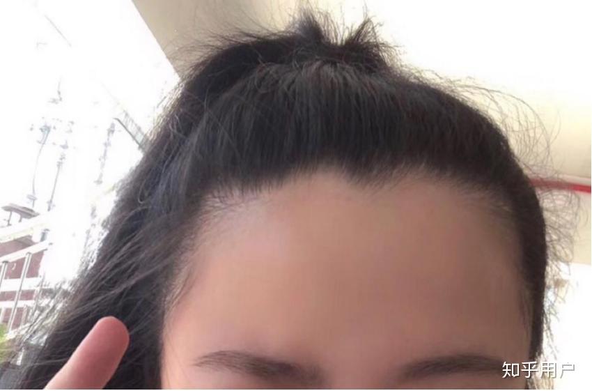 女生秃头怎么办