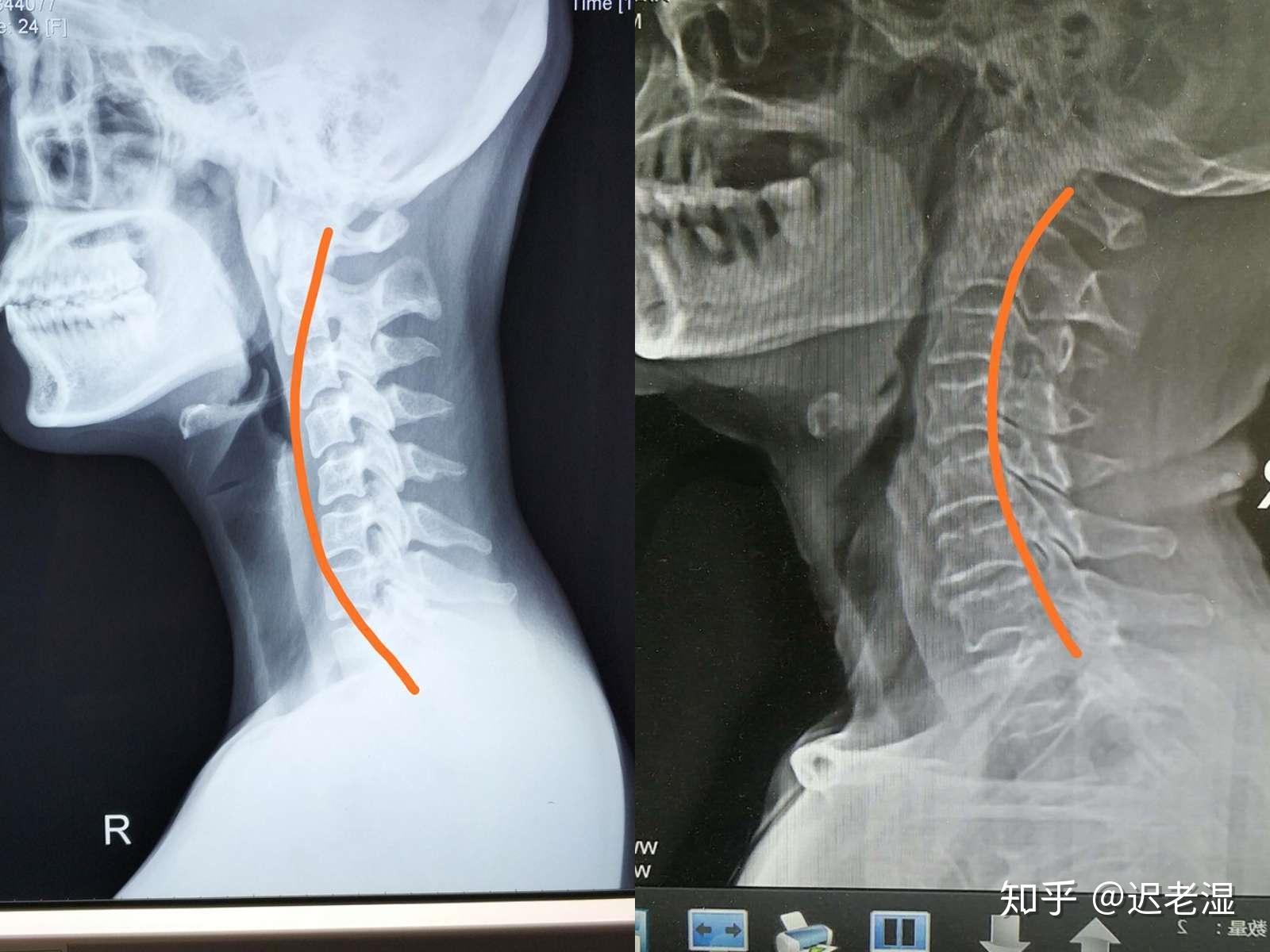 颈椎固定支具-骨科脖子支架