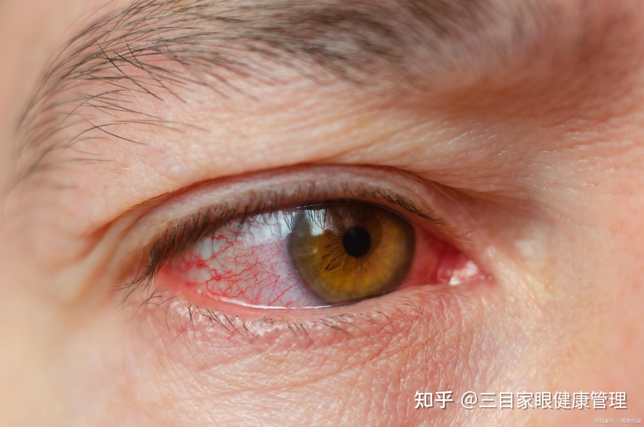 麦粒肿是怎么引起的？它的危害有哪些？ - 知乎