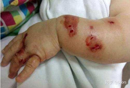 老鼠咬人的伤口是怎么样的,早上醒来发现有两个小针眼的伤口,肿了不