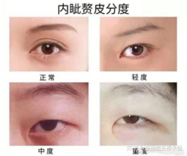 切开重睑联合内眦赘皮矫正术设计要点 - 知乎