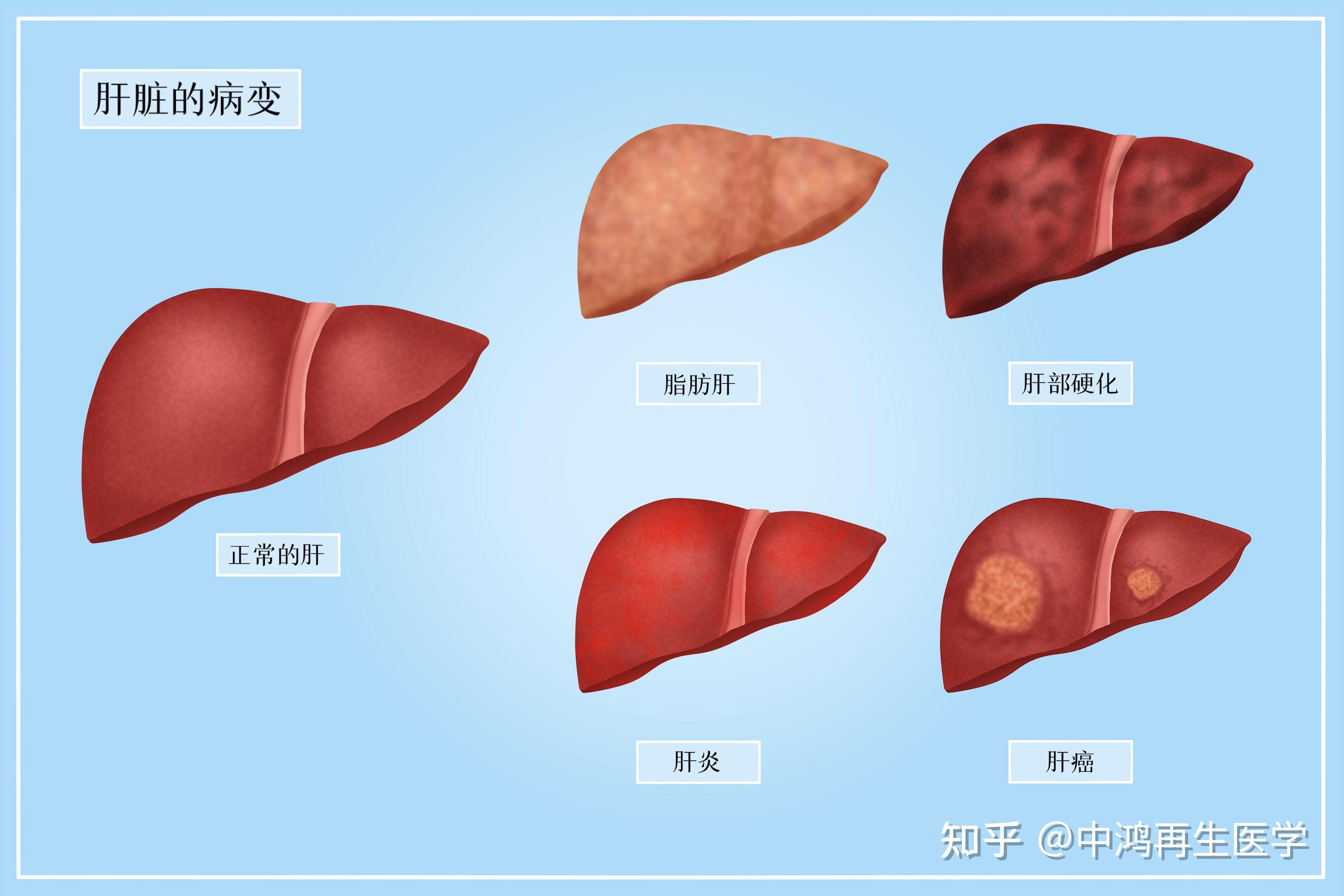 病毒性肝损伤,由病毒感染造成的肝损伤,包括丙肝,乙肝病毒的感染.