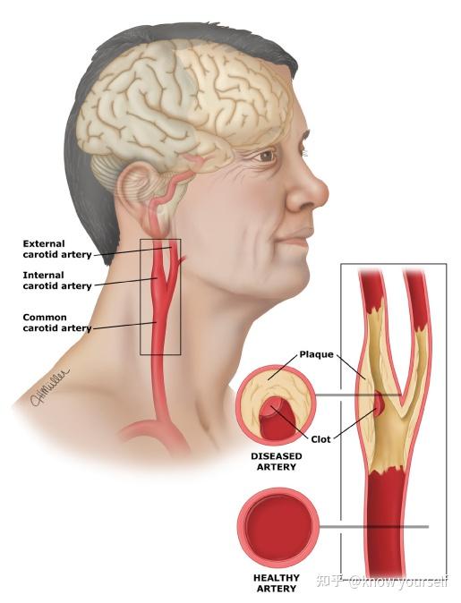 carotid artery颈动脉common carotid artery颈总动脉internal