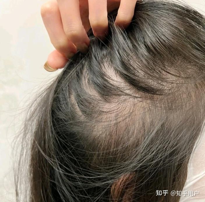 发量封神的秘诀竟是维生素!专家都说:方法用的好,发量不能少! - 知乎