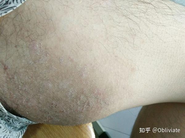 关注问题 ​ 写回答 登录/注册 皮肤病 我这个得的是什么?