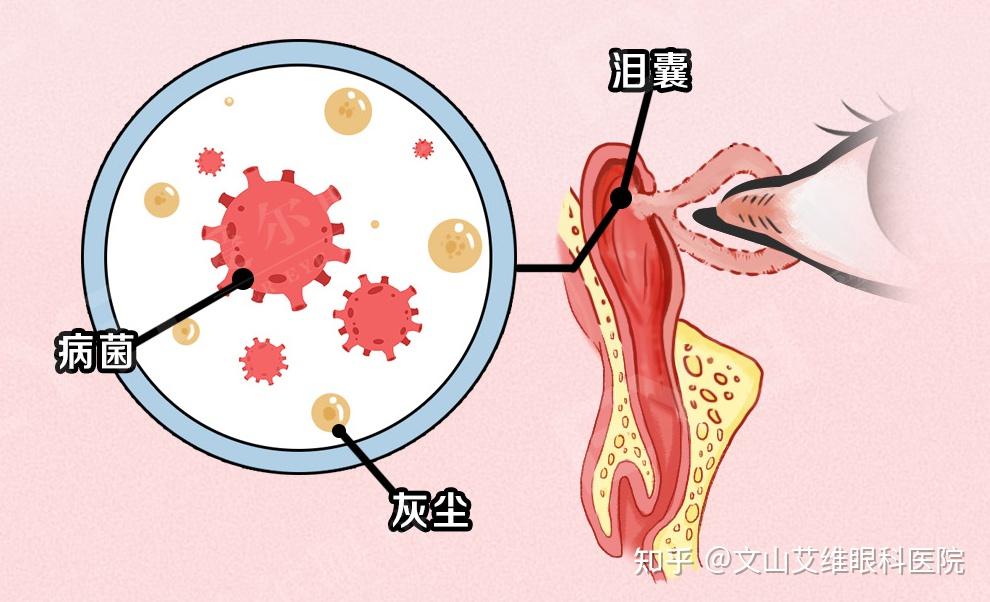 眼屎突然变多,原来是身体悄然亮起的健康"红灯"