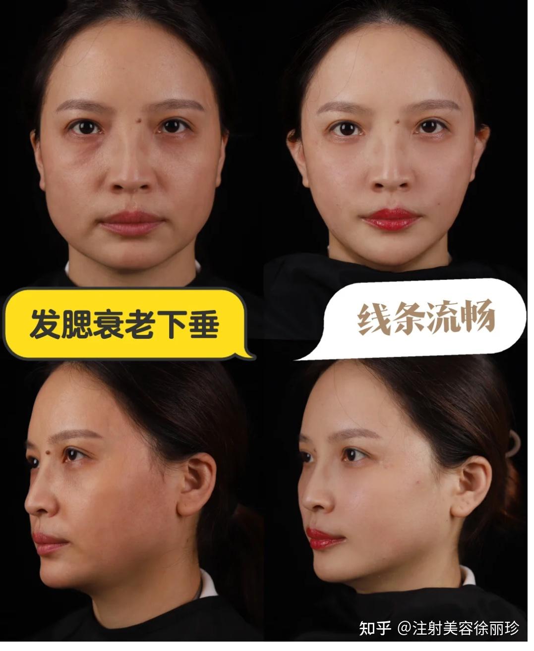 30岁+脸为什么会越来越宽?可能是因为面部发腮带来的! - 知乎