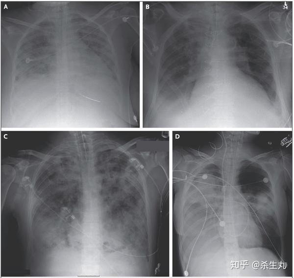 呼吸窘迫综合症ards综述对武汉新冠病毒肺炎重症患者治疗的借鉴意义