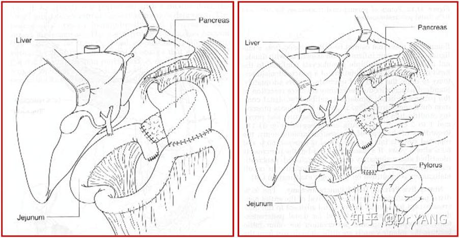 适用于胰头部病变为主的病例,与whipple术类似但保留幽门.