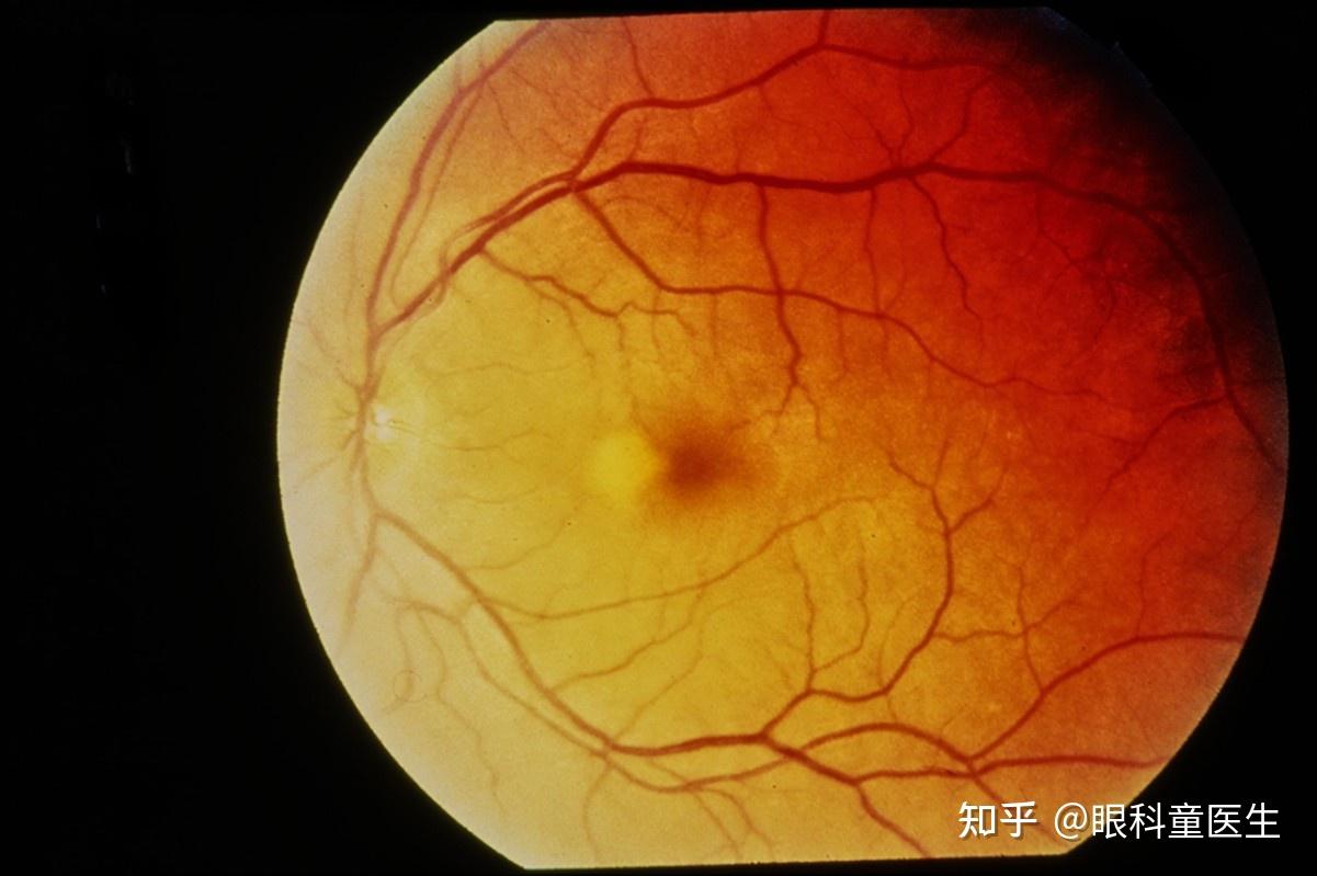 后葡萄膜炎 - 知乎