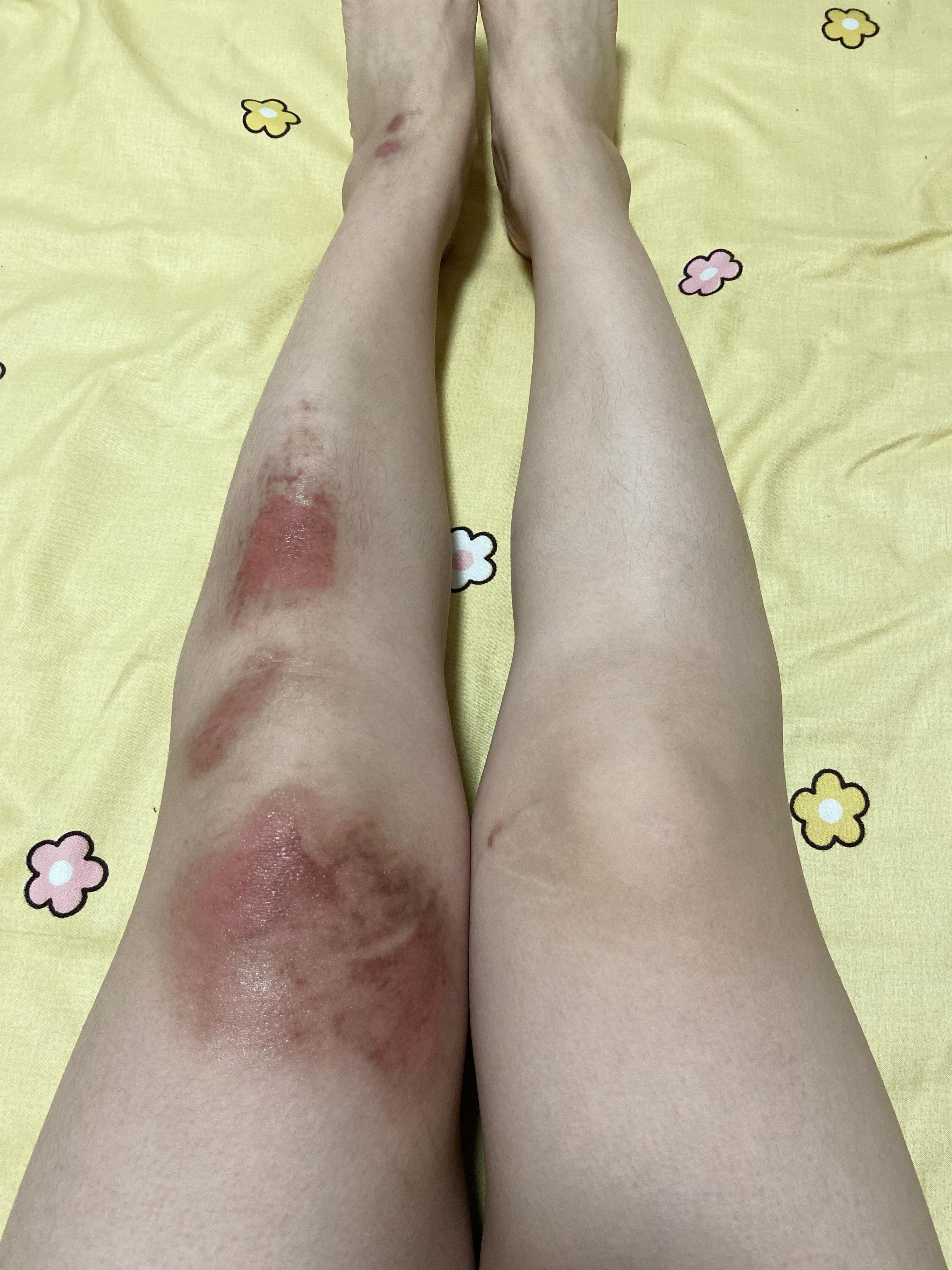 女生膝盖受伤结痂图片图片