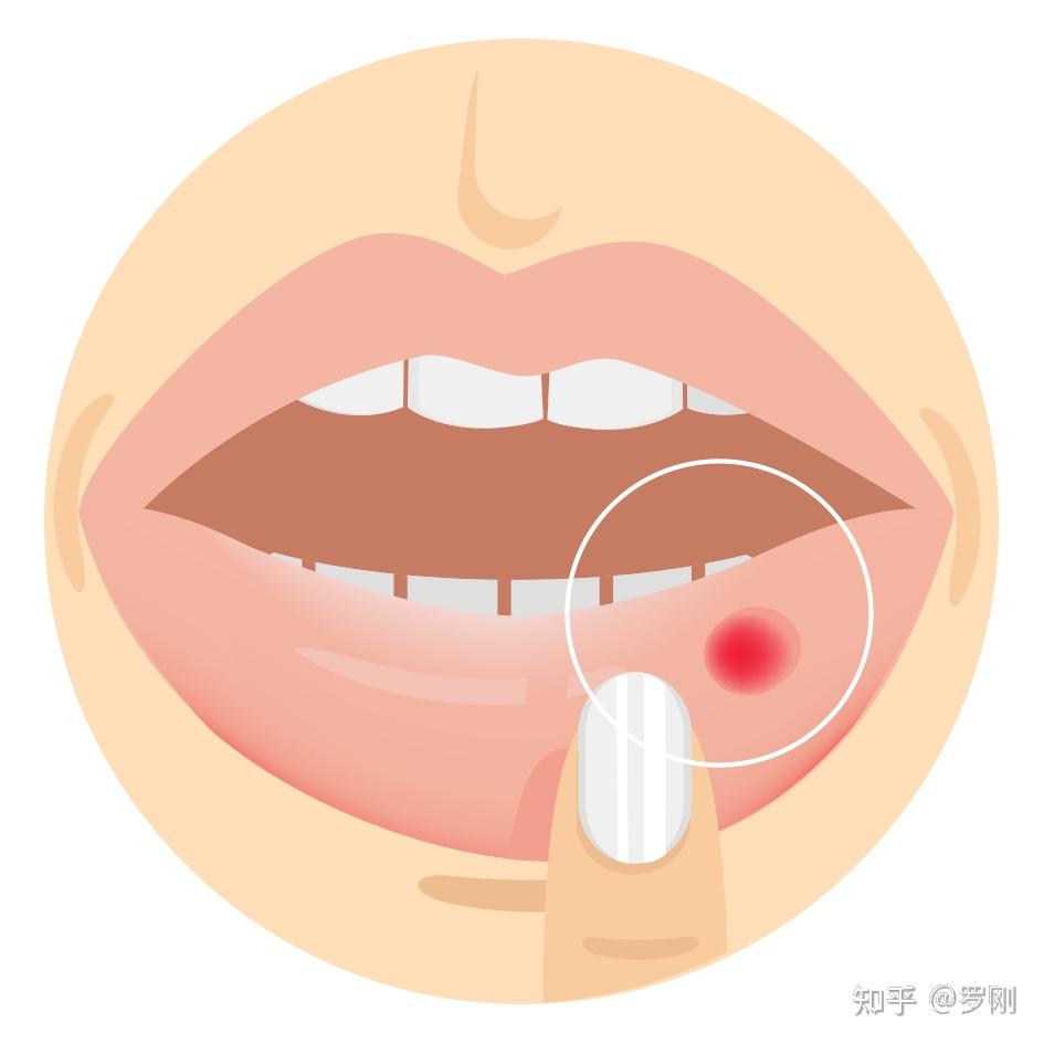 嘴巴里长个小肉球图片图片