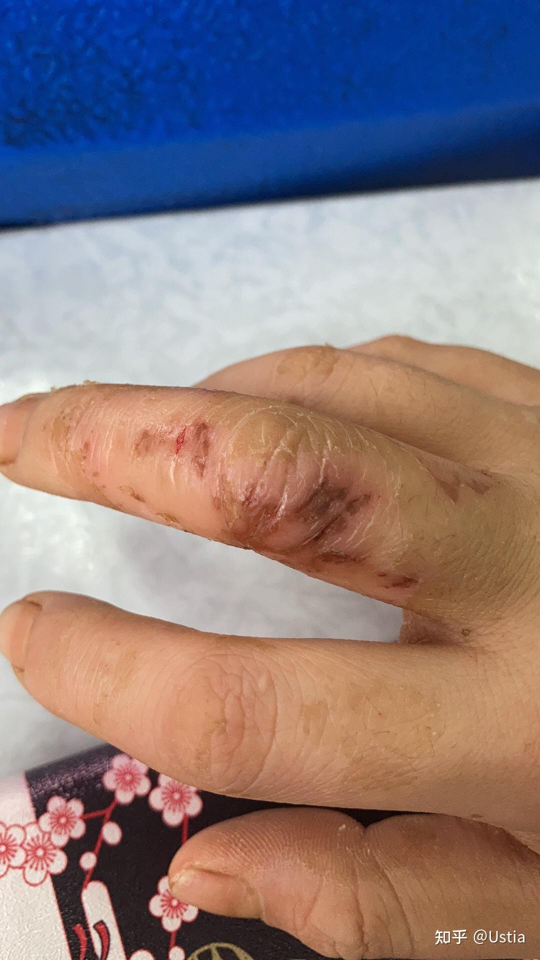 各位大神鄙人手残手指甲旁边长了死皮用指甲刀剪的时候把一些肉也剪了