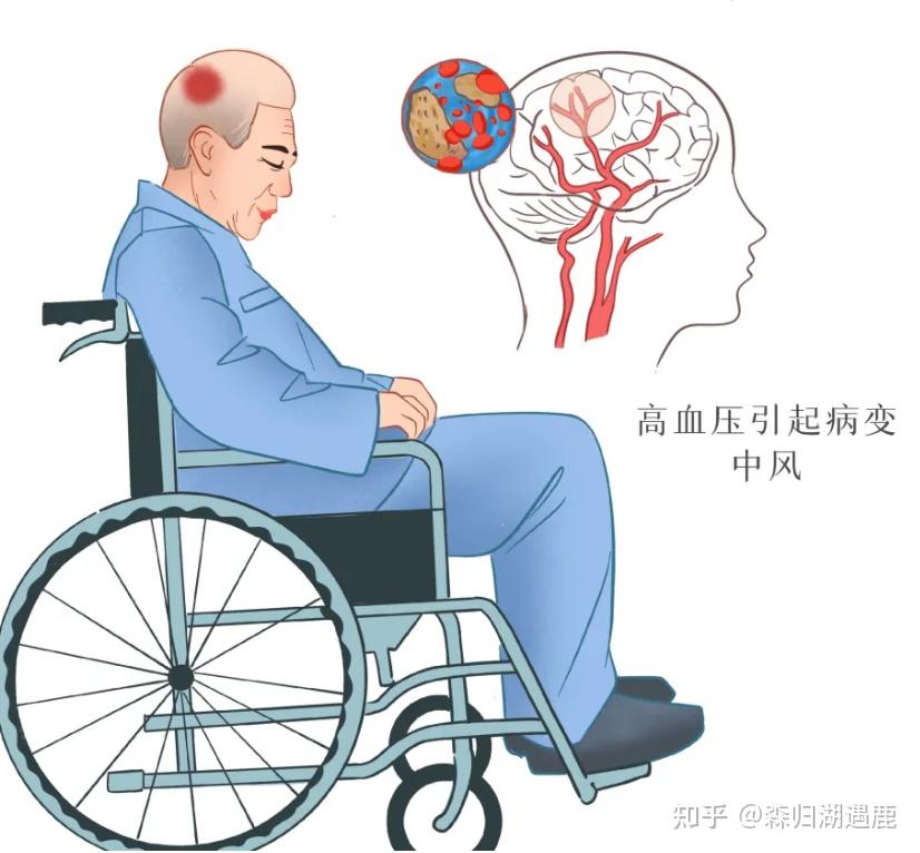 脑内出现小中风病灶的原因有什么? - 知乎
