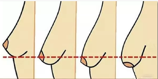 19岁女生有些胸下垂怎么才可以恢复? - 知乎