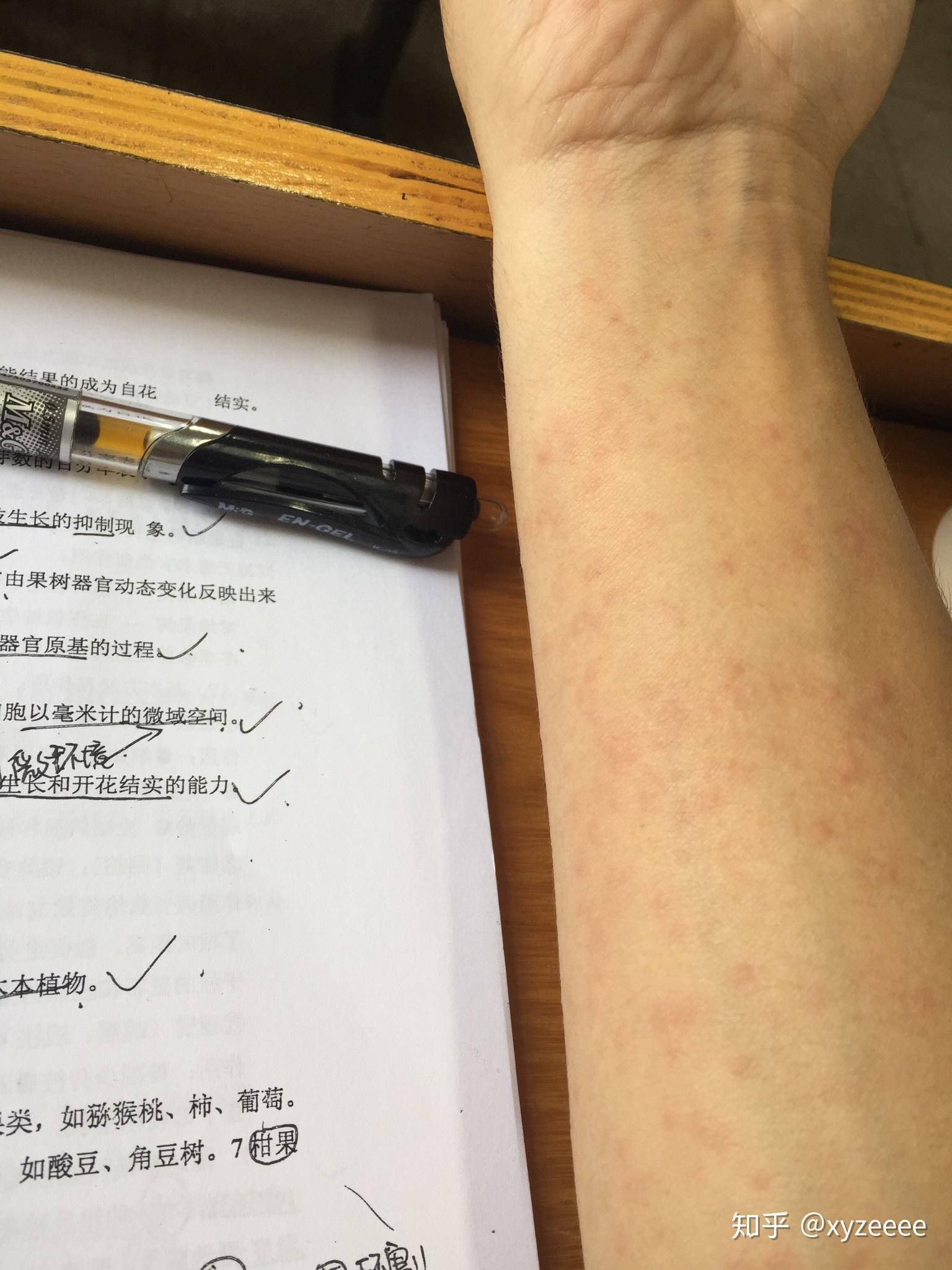 对自己的汗液过敏是什么体验?