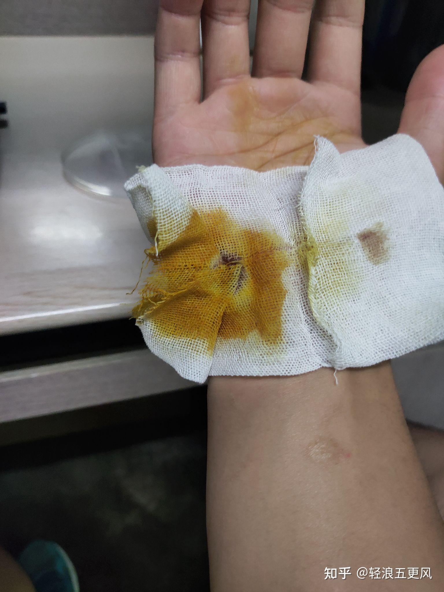 伤口大部分脱离了纱布,但一小处粘连特别紧4.