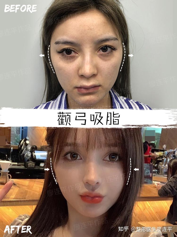 关于颧骨颧弓的五大真相,你知道吗? - 知乎
