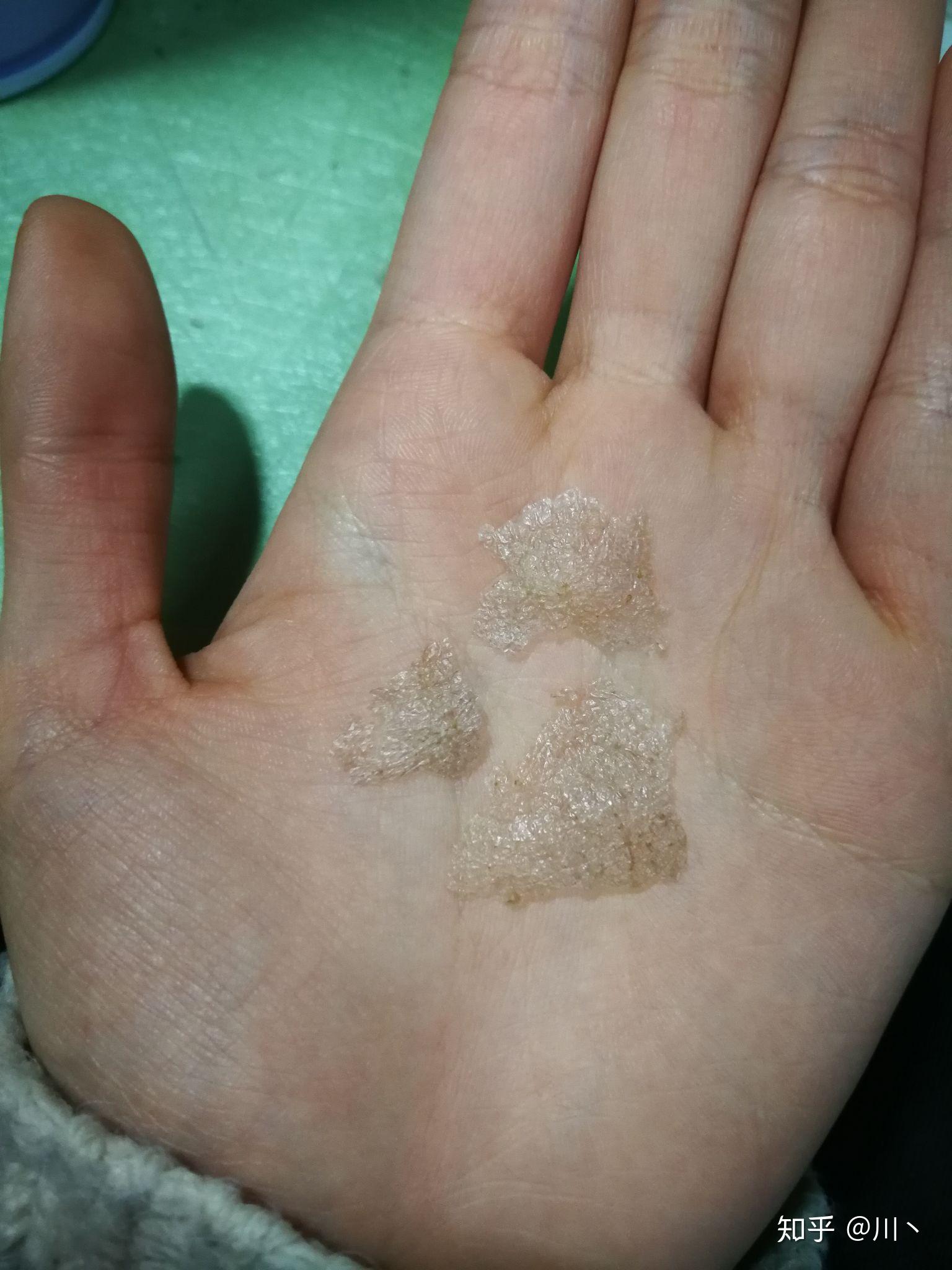 见过的最大头皮屑多大