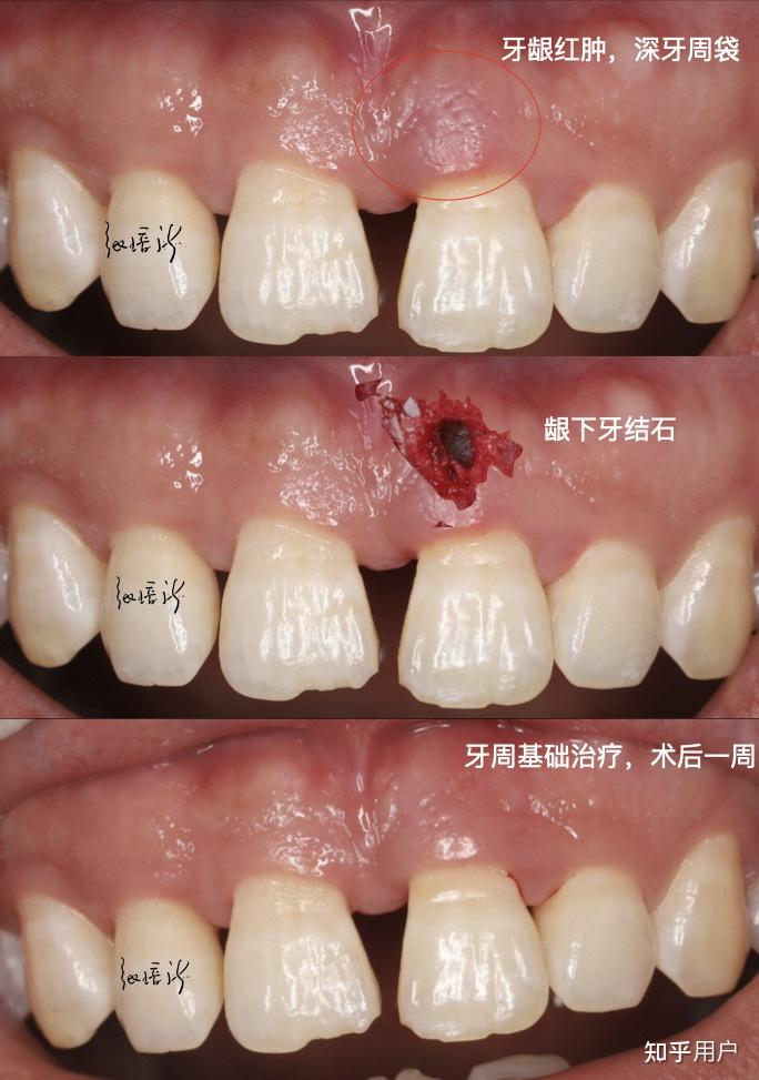 龈下刮治前后对比照片图片