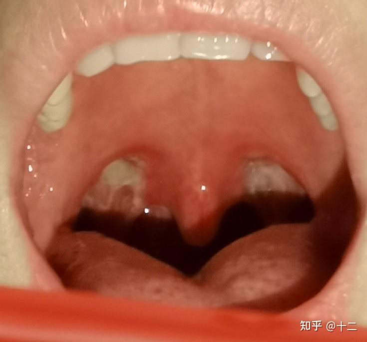 开了康复新液漱口(就是那小强提取物)和喉友口腔抗菌液喷喷,说不要用