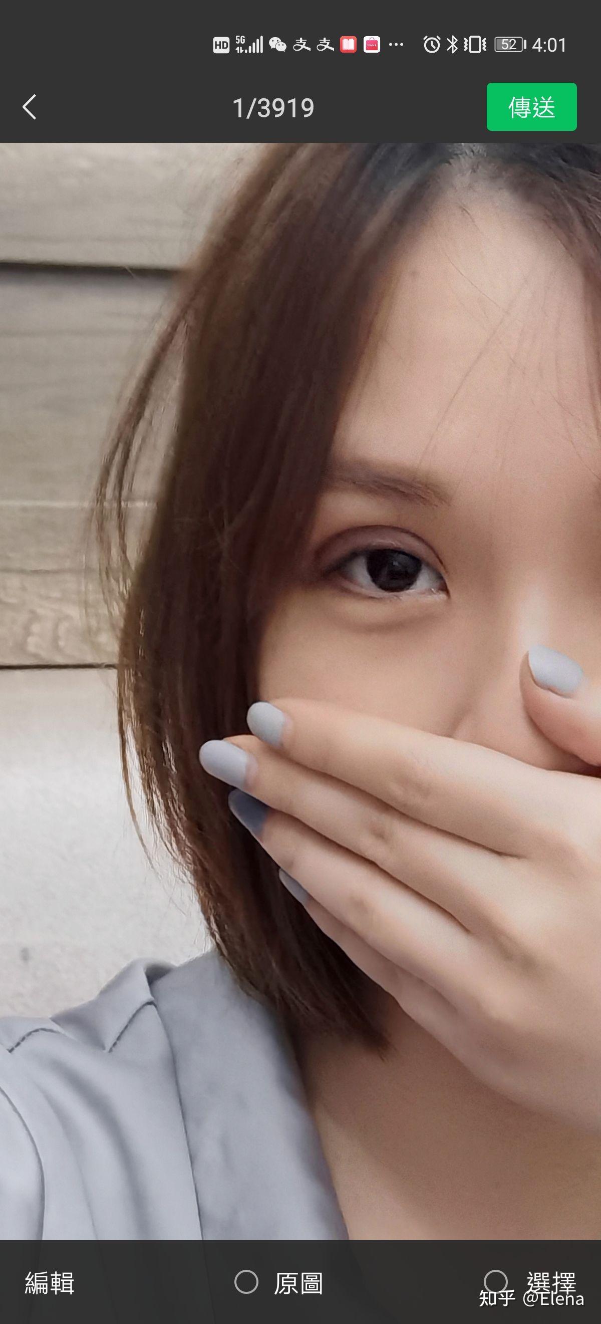 记录一下肿眼泡的埋线双眼皮.