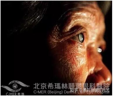 白内障术后注意事项有哪些 知乎