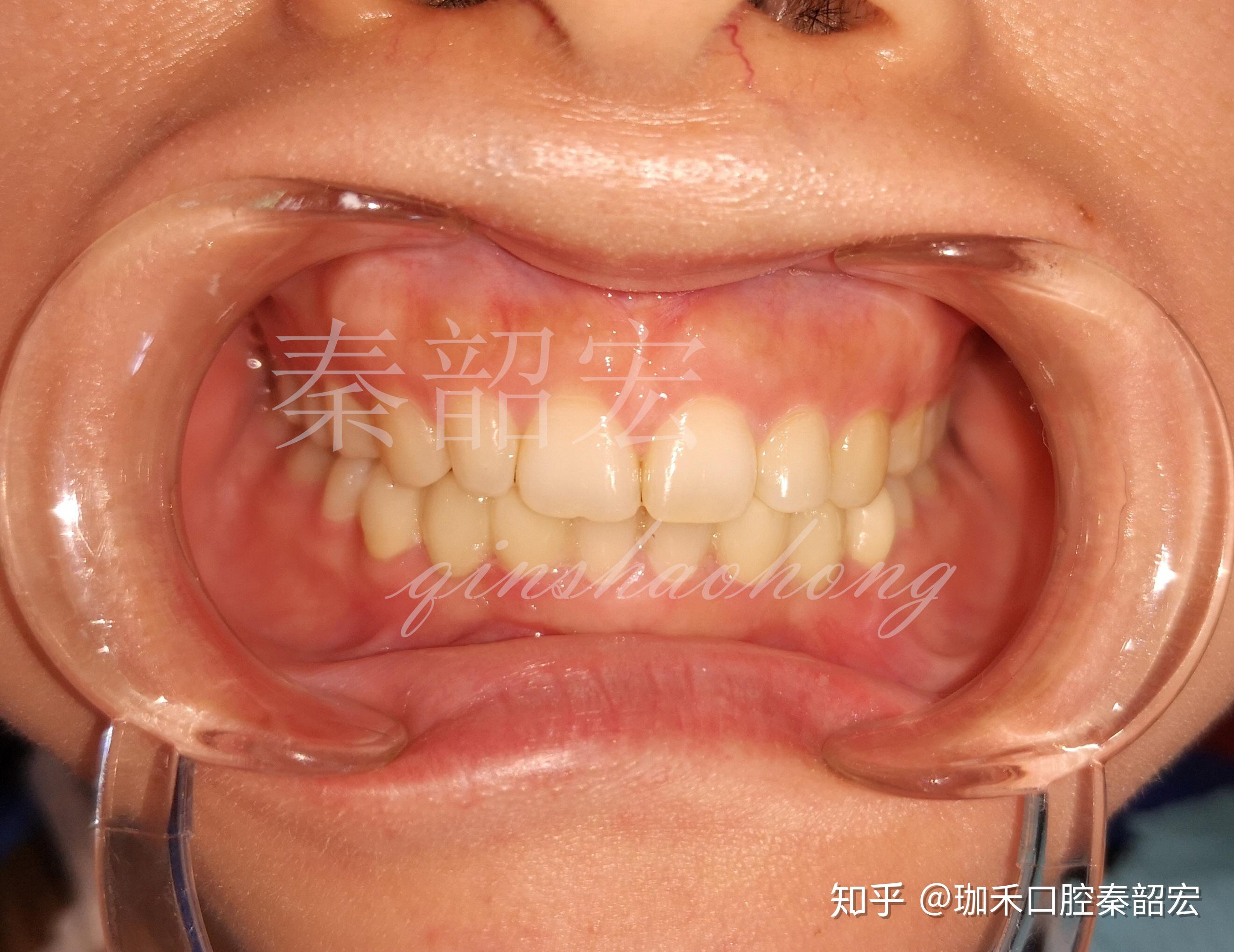 二、牙周翻瓣术的适应证及术后愈合方式-口腔临床指导-医学