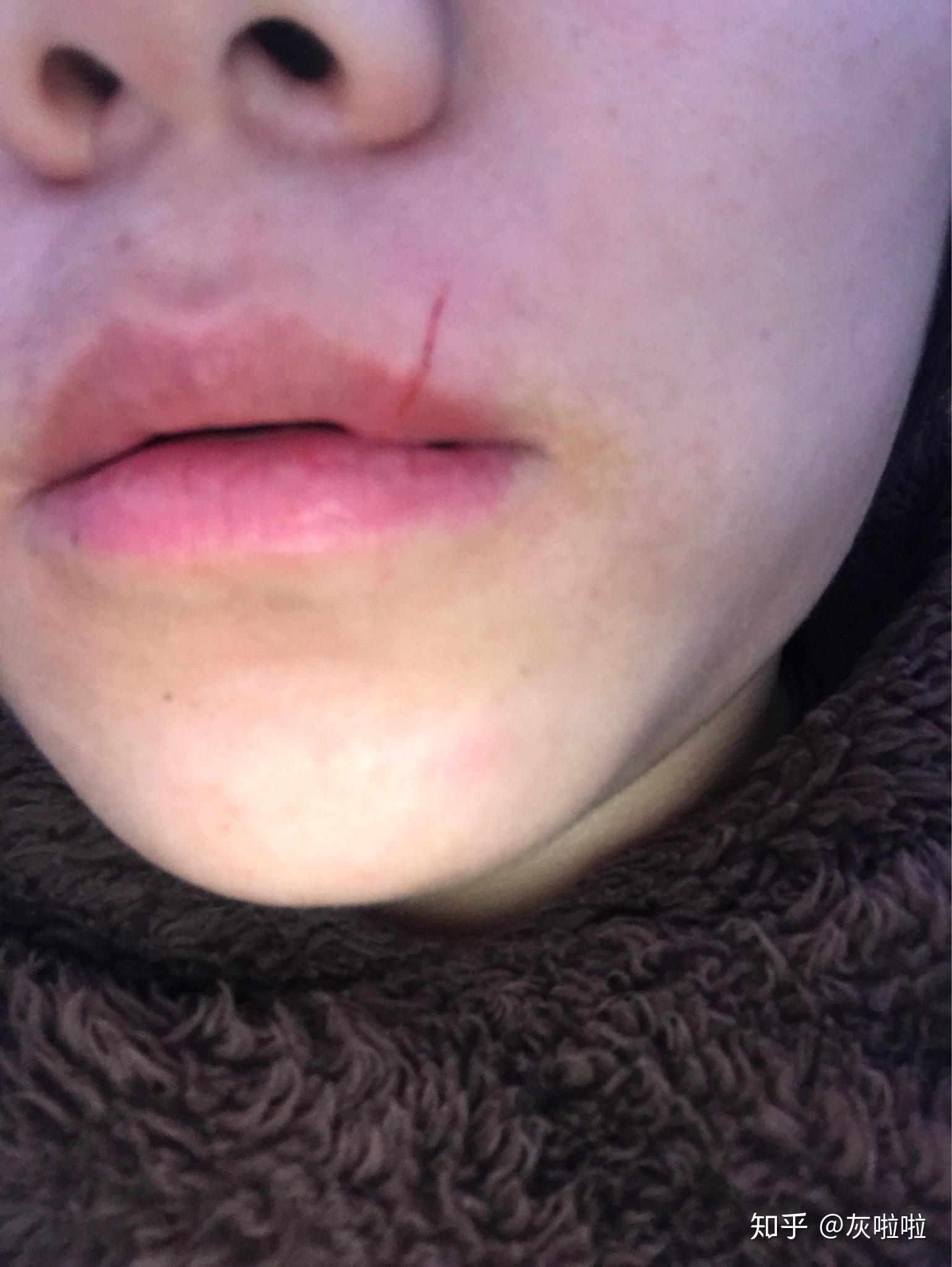 被家里的猫抓到嘴唇出血了怎么办