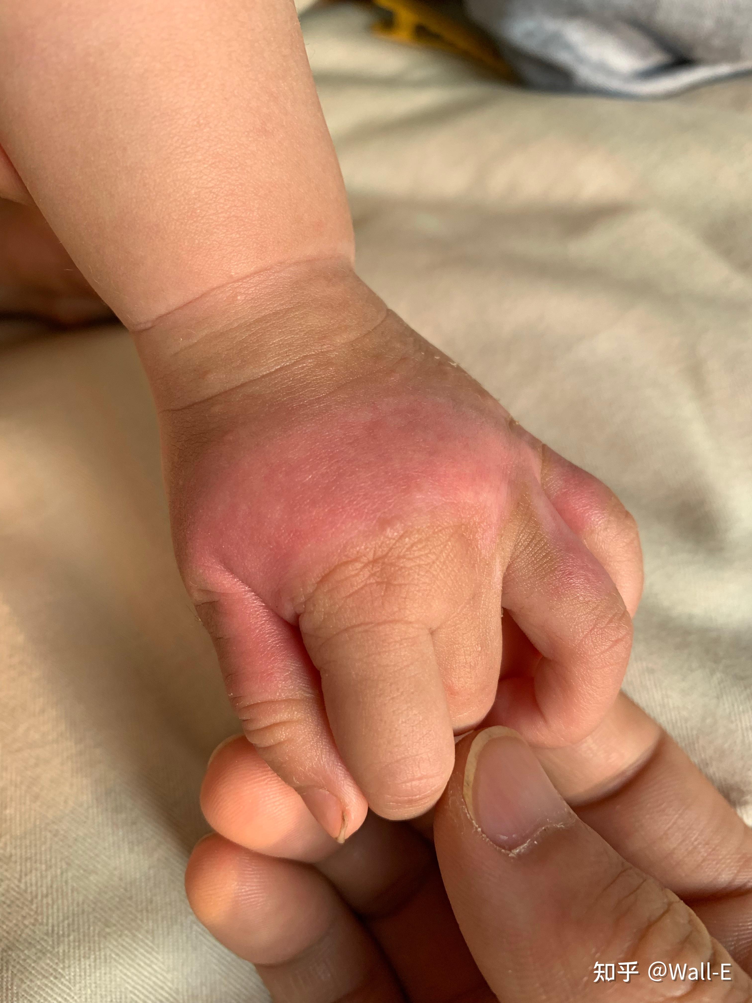 烫伤第一时间怎么处理女儿被烫伤的时候刚一岁两个月,小手还特别娇嫩