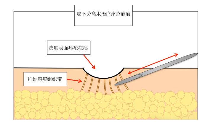 【乾貨分享】關於皮下剝離(皮下分離)的那些冷知識