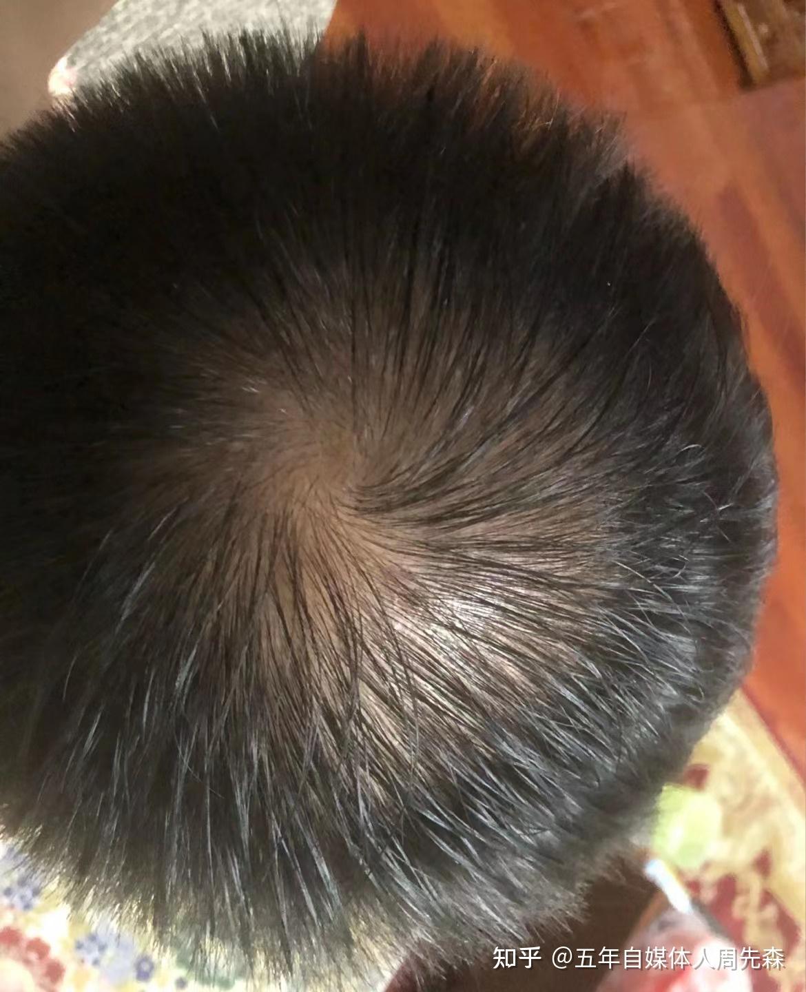 发旋处头发太少了!,我是不是要秃了,怎么办啊! - 知乎