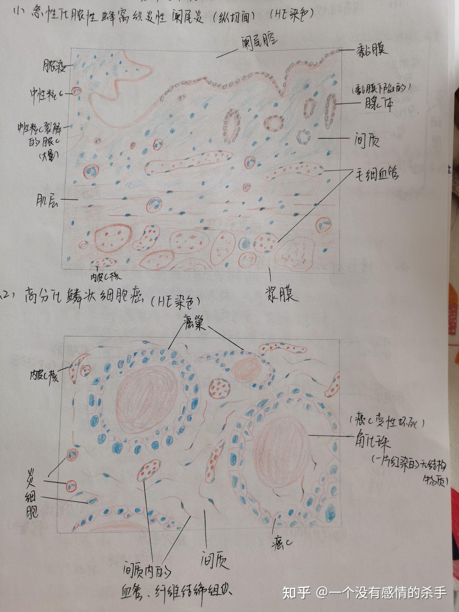 阑尾切片手绘图图片