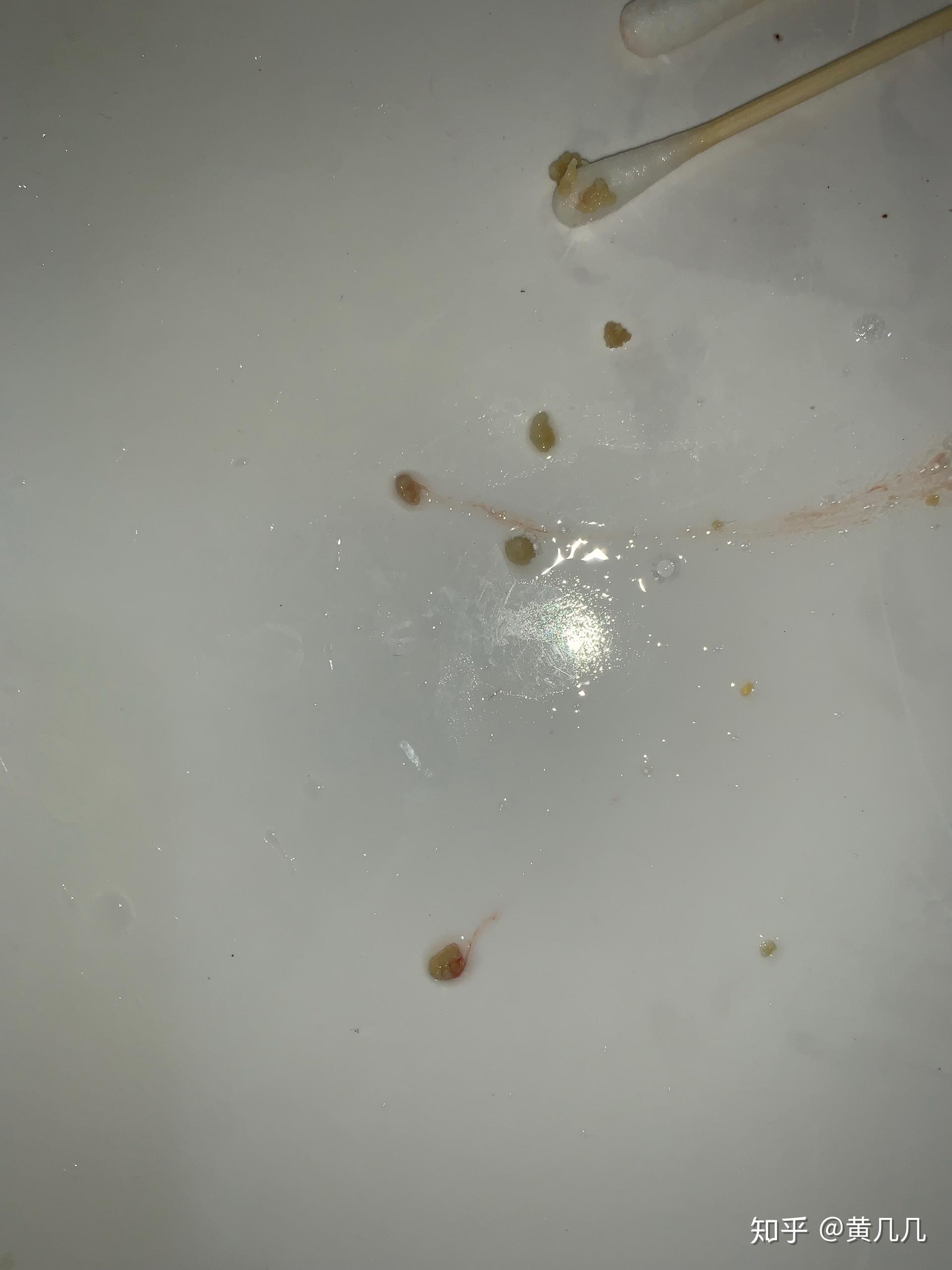 喉咙里偶尔会吐出很臭的小颗粒,医生说是扁桃体结石,做了扁桃体摘除