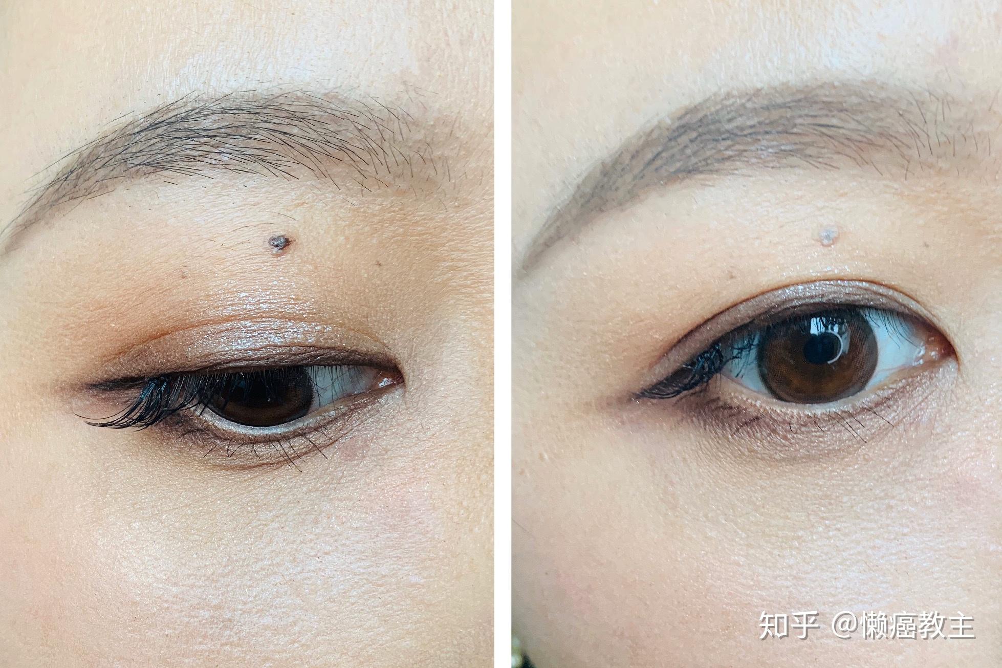 为什么有人说妖痣可怕,妖痣究竟长在哪里? - 知乎