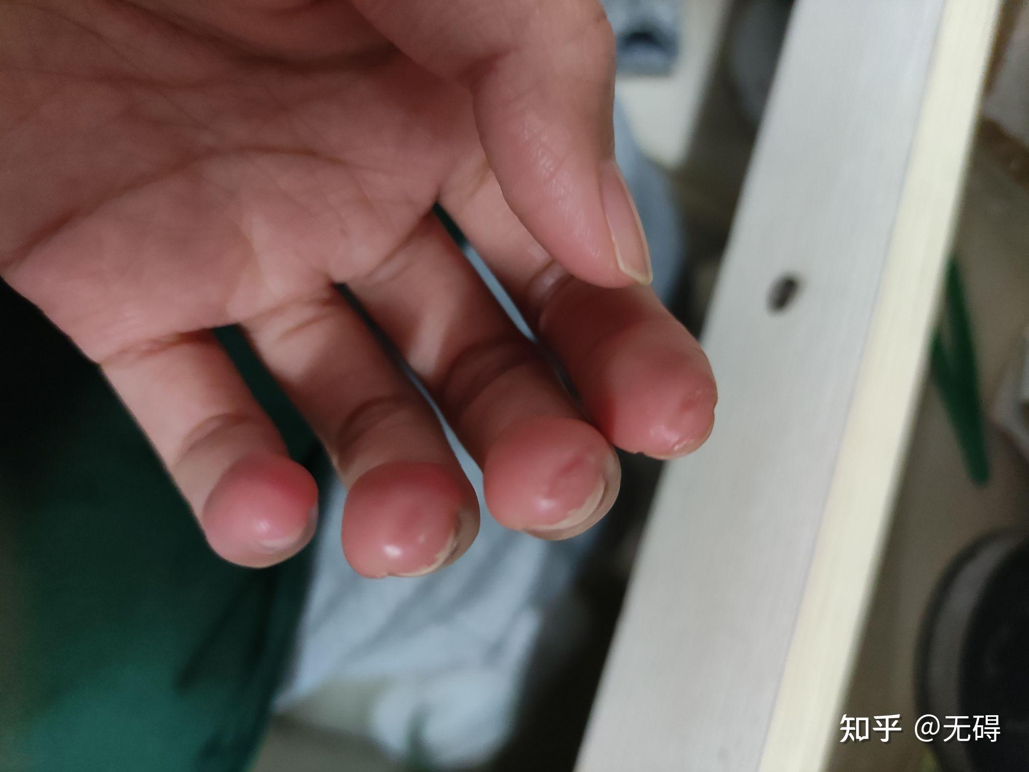 玩吉他的朋友可以拍一张左手手指上的茧吗? - 知乎