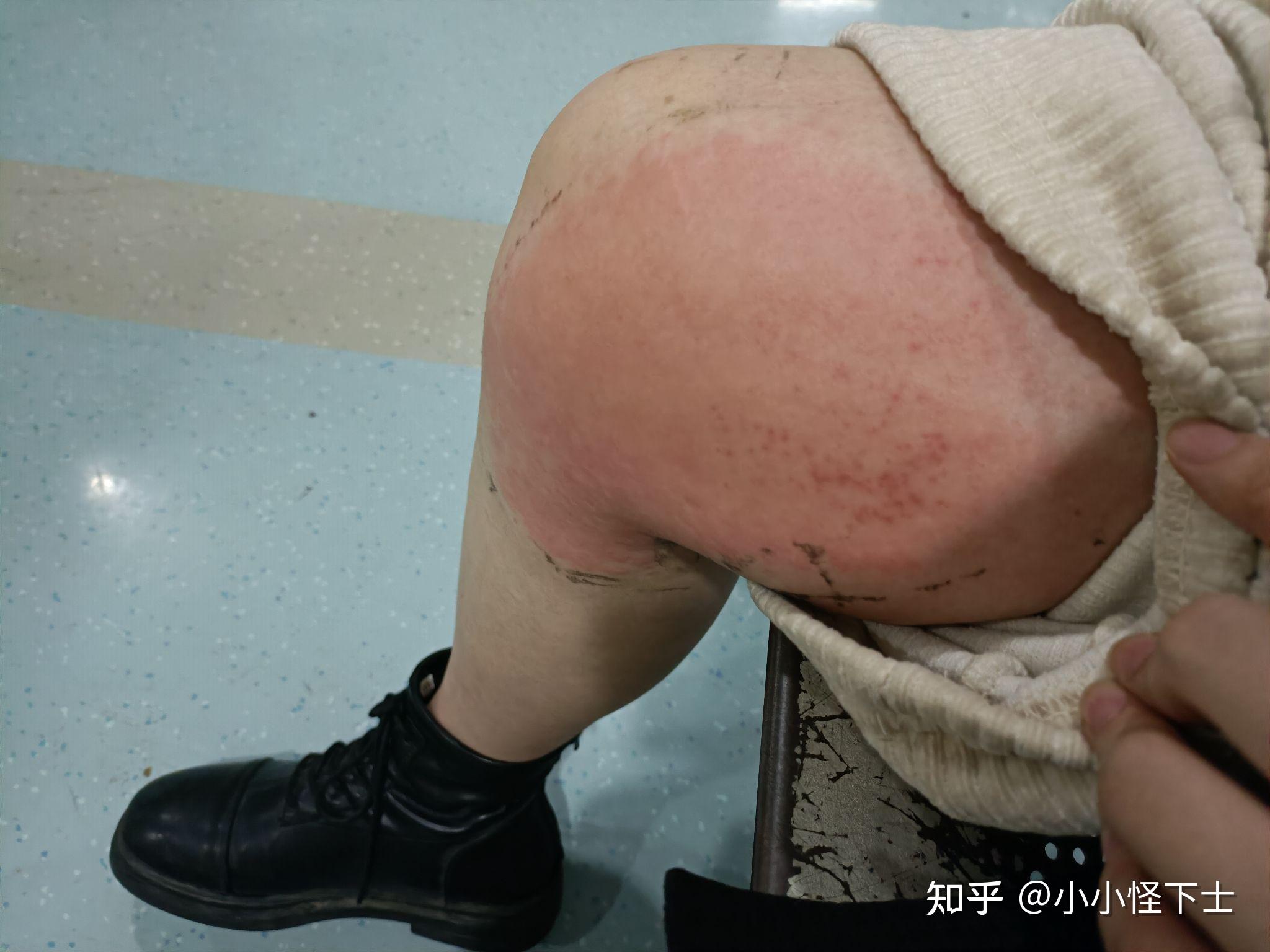 贴膏药导致的接触性皮炎