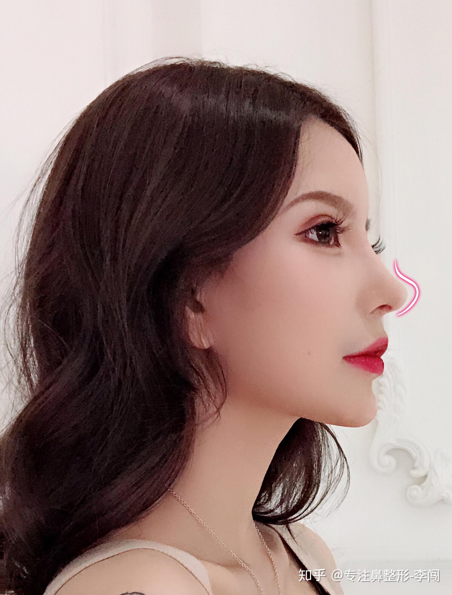 鼻翼整形的干货分享你真的适合做外切吗