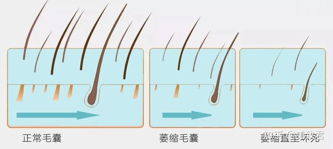 脫髮能不能自行恢復?怎麼判斷脫髮?毛囊萎縮和毛囊壞死的區別?