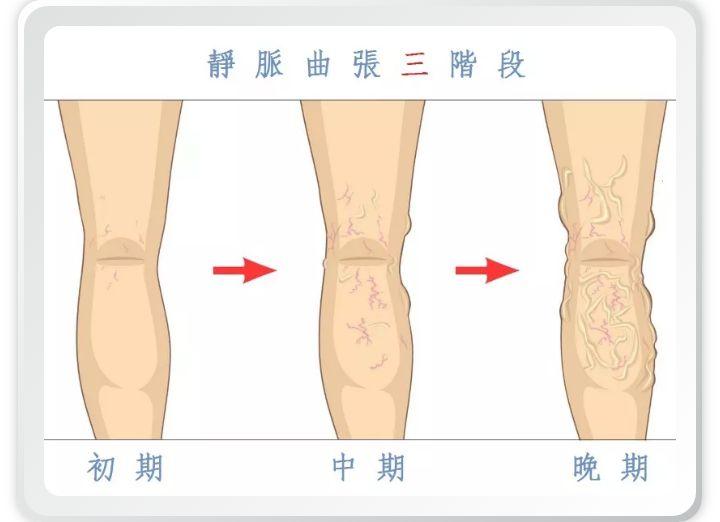 静脉曲张你了解多少