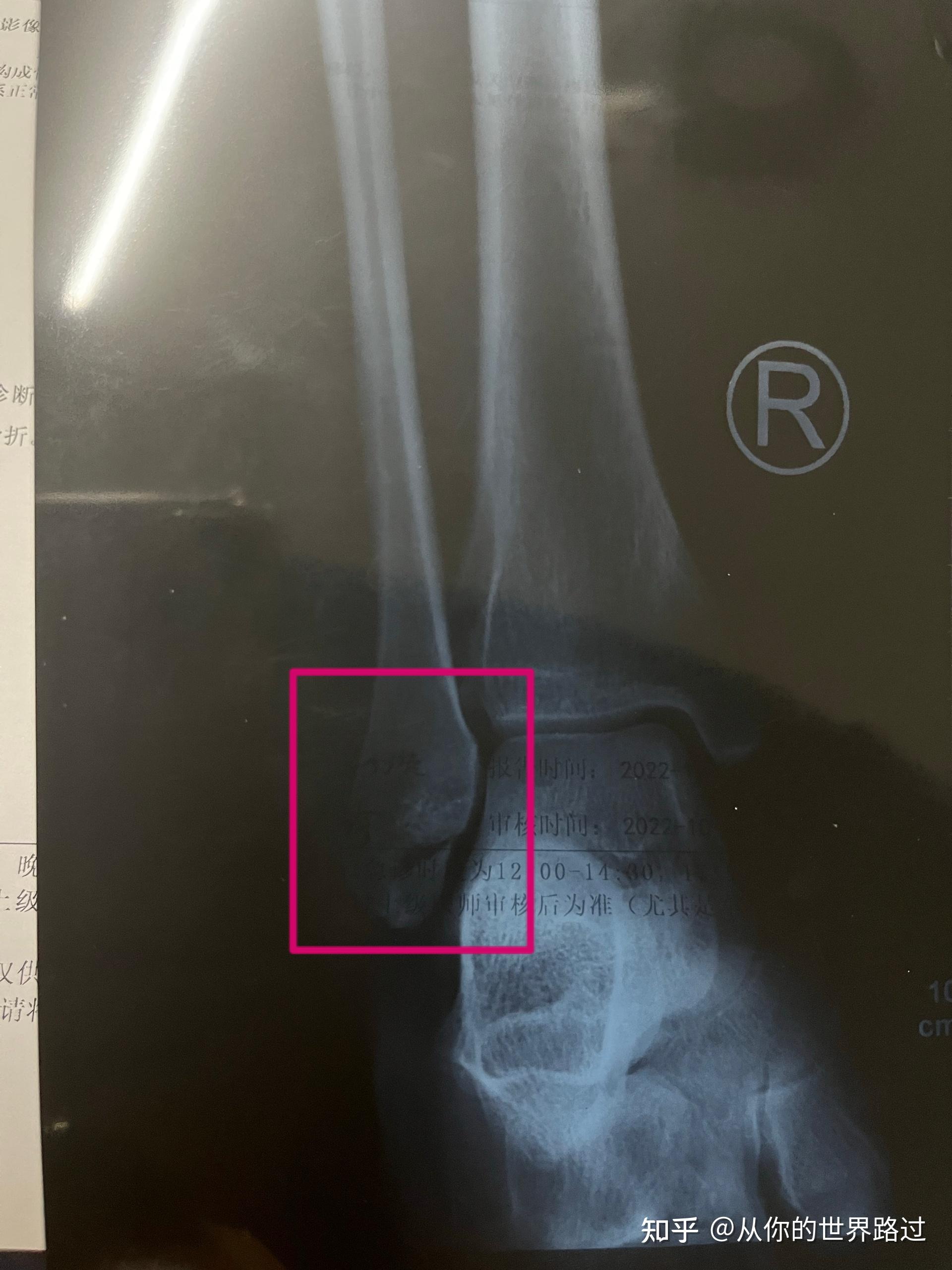 右外踝骨折图片图片
