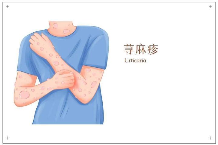 荨麻疹是怎么引起的?这四种原因可不能小觑!中医教你如何做 - 知乎