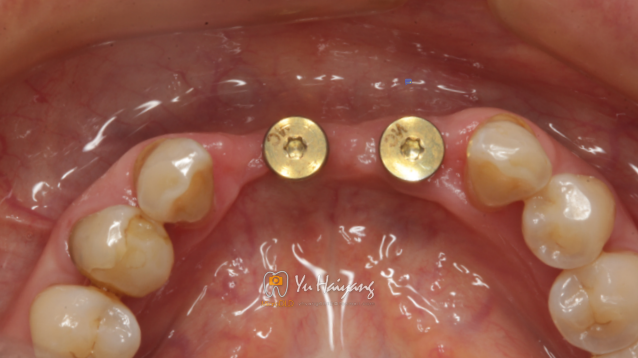 下前牙连续缺失延期种植⼀例 - 知乎