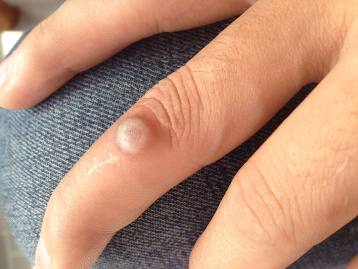 手上长小包包了,傻傻分不清是老茧,还是瘊子!