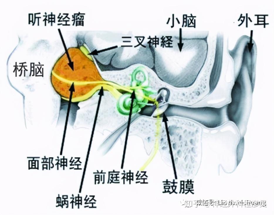 听神经瘤常见问题
